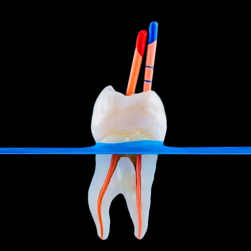 Tooth diagram showing root canal anatomy for painless root canal treatment in Gwalior